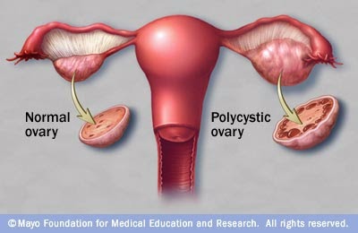 How long does it take for a cyst to grow on your&nbsp;ovary?
