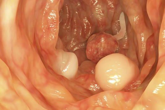 8 Symptoms of Colon&nbsp;Polyps