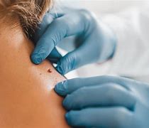 Understanding Skin Tags