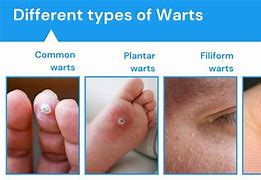 Warts can be challenging to remove. The following methods can assist in their&nbsp;elimination.