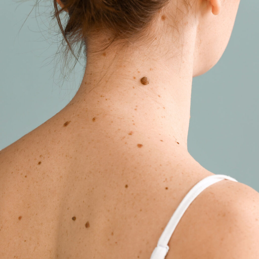 What is the Differences Between Mole, Wart, and Skin&nbsp;Tag