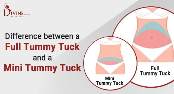 What Are the Advantages of Mini&nbsp;Abdominoplasty?