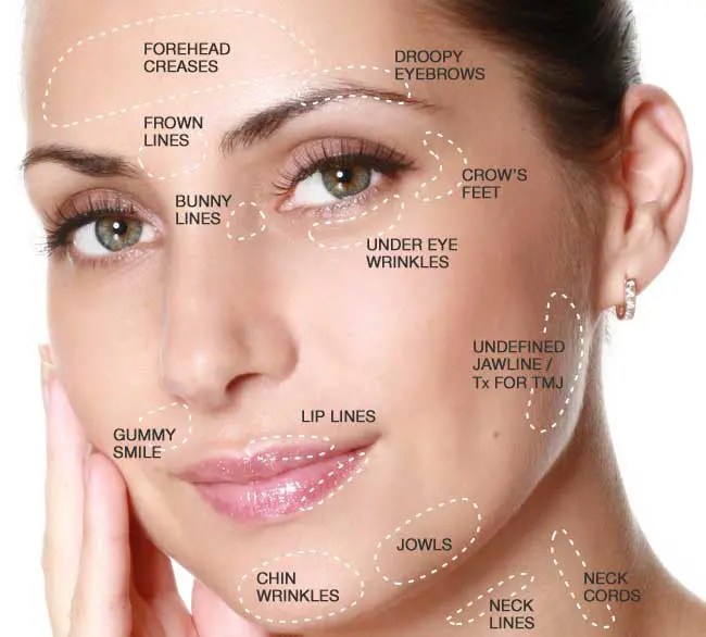 How Many Units of Botox for Forehead? Dosage, Cost, and What to&nbsp;Expect