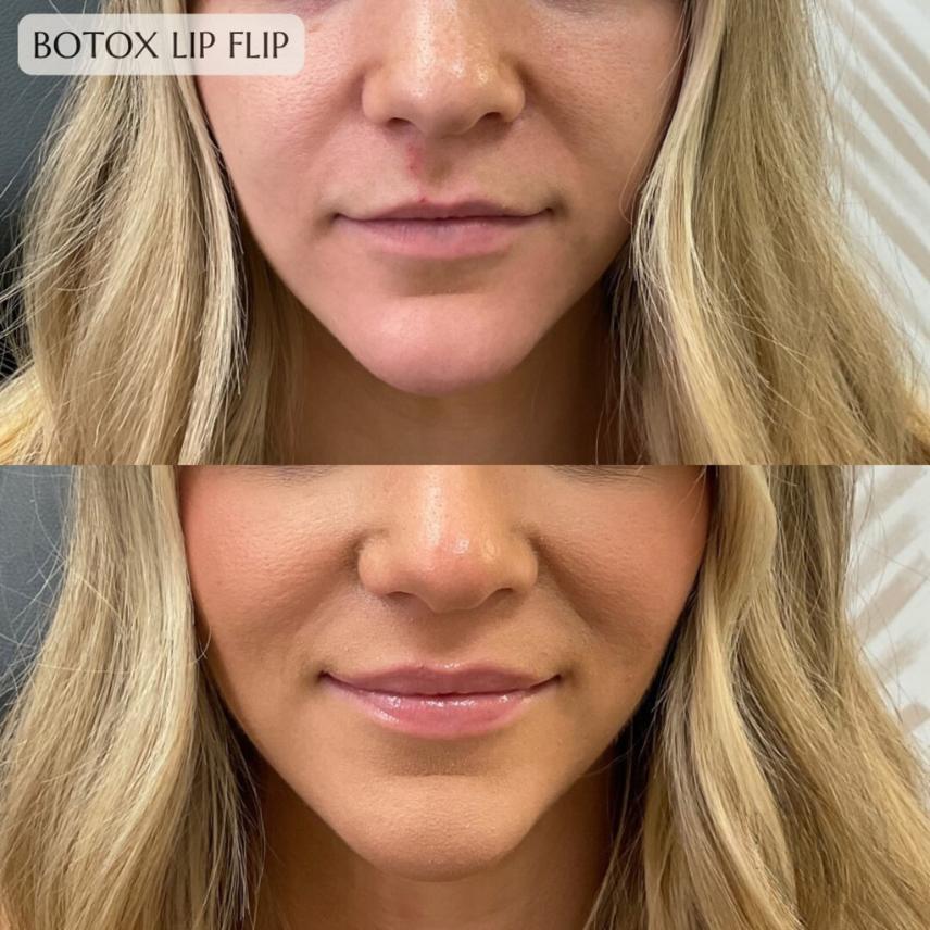 Botox Lip Flip: What It Is, How It Works, and How Long It Really&nbsp;Lasts
