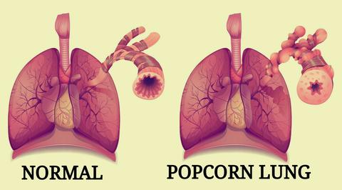 Nevada teen develops serious ‘popcorn lung’ conditions after vaping for three&nbsp;years