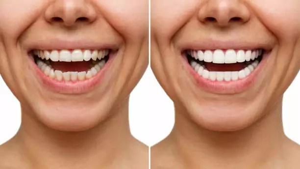 Veneers vs. Teeth Whitening: Which is Right for Your&nbsp;Smile?